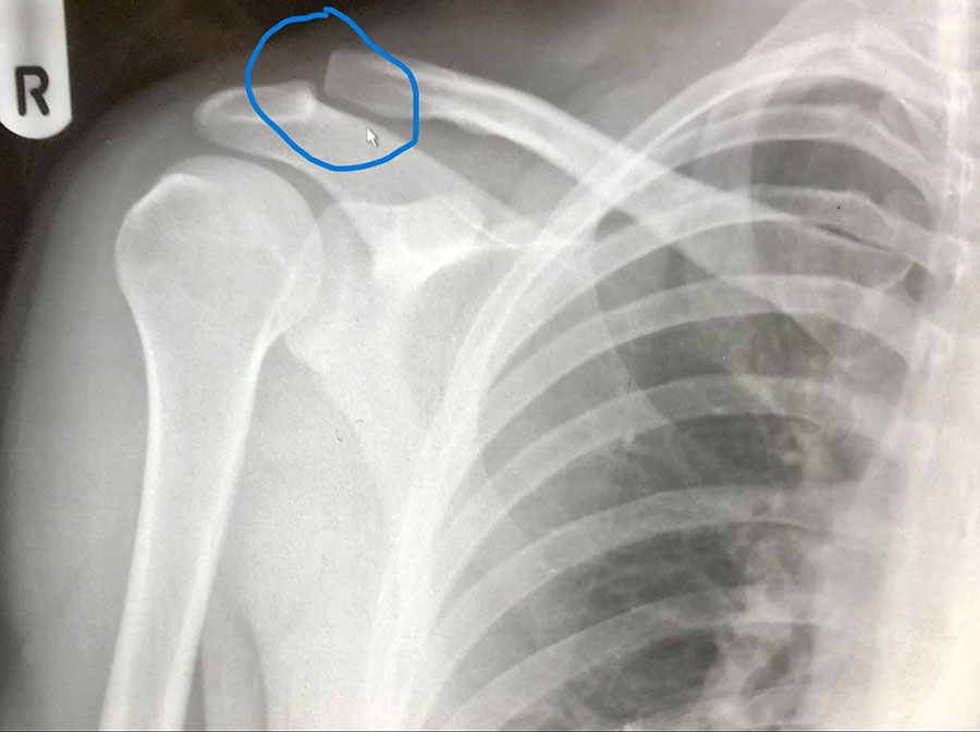 X-ray showing Mike's dislocated AC joint - ouch!